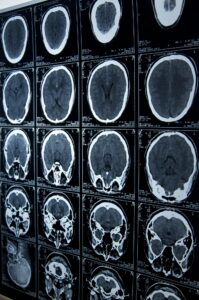 Brain Injury Lawyer in Salt Lake City, UT